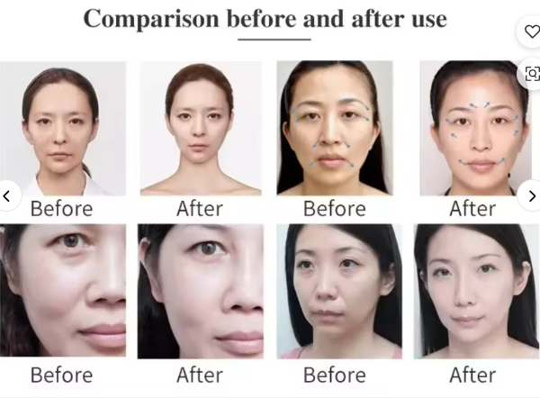 10 Máquina de Ultrasonido para Lifting Facial