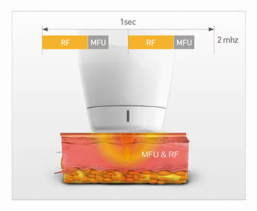 3 Máquina de Ultrasonido para Lifting Facial