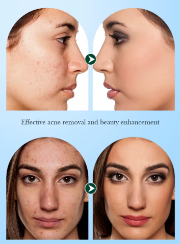 Mascarilla facial Hidratante Herbal Anti-Acné SADOER